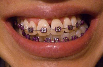 purple braces on black girl.